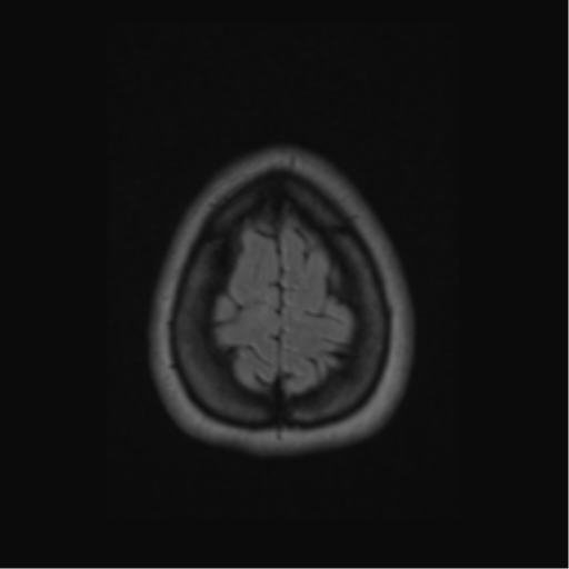 Acute disseminated encephalomyelitis (ADEM) (Radiopaedia 38073-40065 Axial FLAIR 62).png