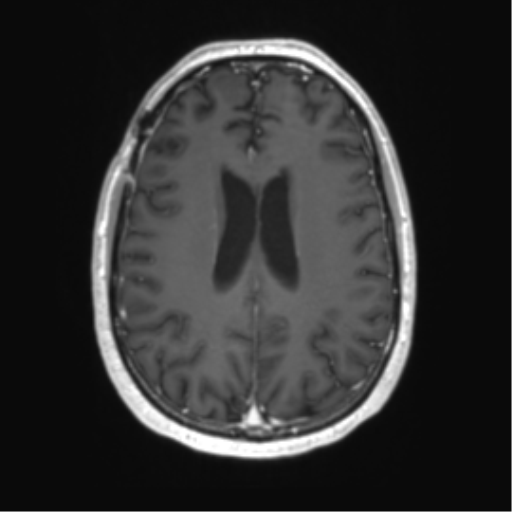 Acute disseminated encephalomyelitis (ADEM) (Radiopaedia 65319-74350 Axial T1 C+ 41).png