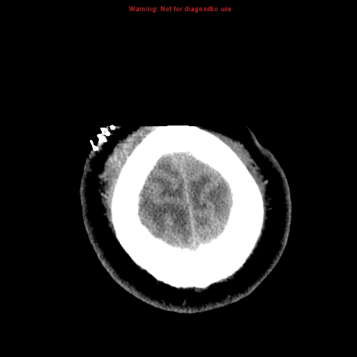 File:Acute hemorrhagic leukoencephalitis (Radiopaedia 14076-72275 Axial non-contrast 44).jpg