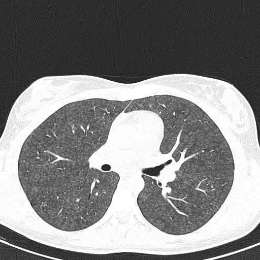 File:Acute hypersensitivity pneumonitis (Radiopaedia 85293-100870 Axial lung window 52).jpg