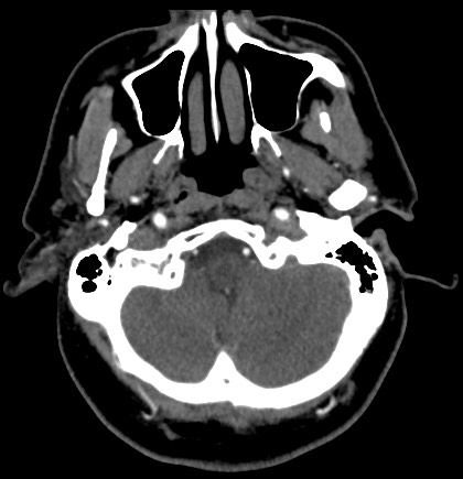 Acute internal carotid artery dissection (Radiopaedia 53541-59630 Axial C+ arterial phase 9).jpg