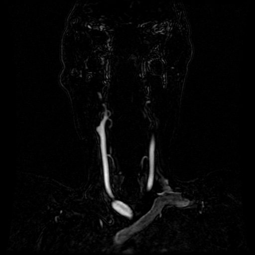 Acute internal carotid artery dissection (Radiopaedia 53541-59632 Coronal MRA 67).jpg