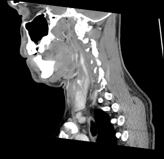 Acute longus colli calcific tendinitis (Radiopaedia 72495-83036 Sagittal C+ arterial phase 43).jpg