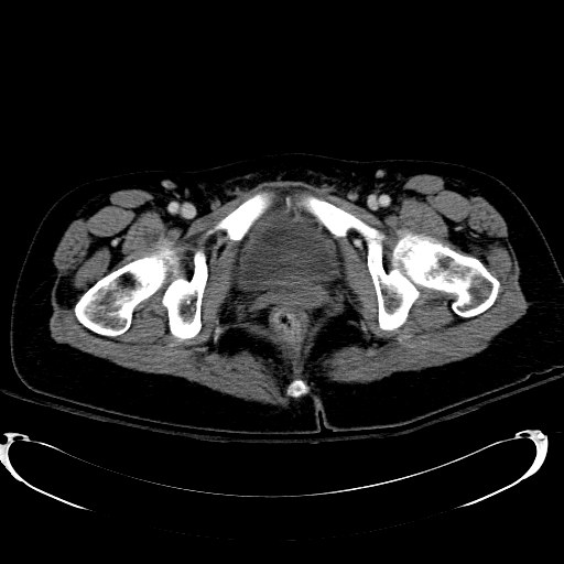 Acute myocardial infarction in CT (Radiopaedia 39947-42415 Axial C+ portal venous phase 134).jpg