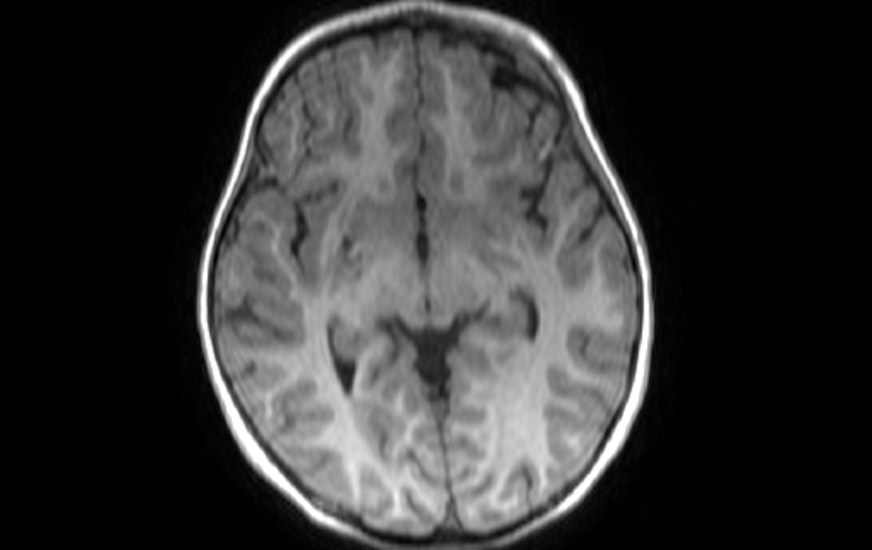 Acute necrotizing encephalitis of childhood (Radiopaedia 67356-76737 Axial T1 53).jpg