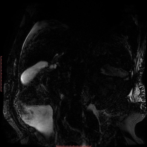 Acute necrotizing pancreatitis (Radiopaedia 28194-28448 Coronal MRCP 34).jpg