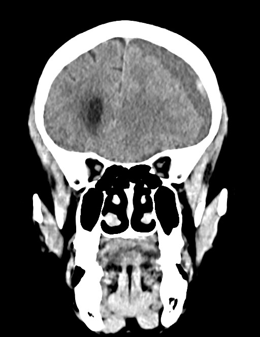 Acute on chronic subdural hematoma (Radiopaedia 74814-85823 Coronal non-contrast 21).jpg