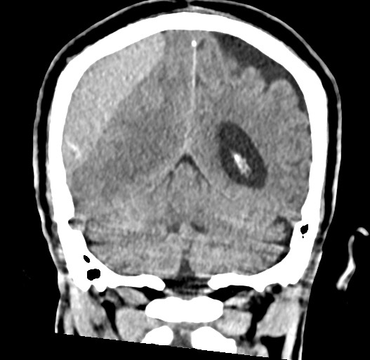 Acute on chronic subdural hematoma (Radiopaedia 78346-90966 Coronal non-contrast 48).jpg