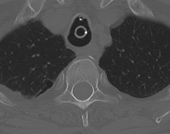 Acute on chronic subdural hematoma and thoracic vertebral injury in a multitrauma patient (Radiopaedia 31698-32619 Axial bone window 65).jpg