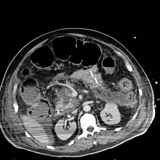 Acute pancreatic necrosis (Radiopaedia 13560-18501 Axial C+ portal venous phase 54).jpg