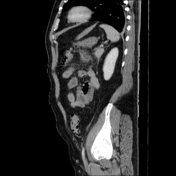 Acute pancreatitis (Radiopaedia 26663-26813 Sagittal C+ portal venous phase 57).jpg