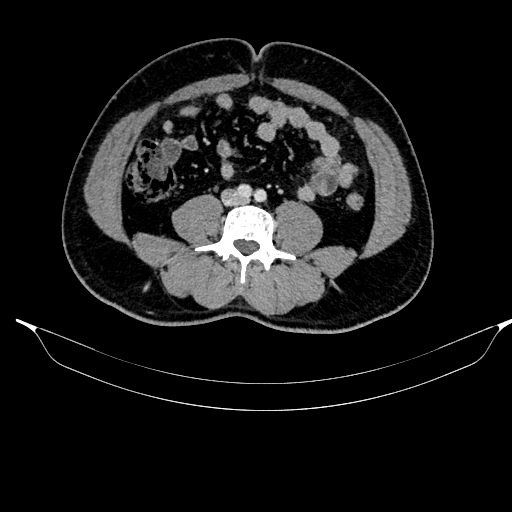 Acute pancreatitis (Radiopaedia 87428-103757 Axial C+ portal venous phase 62).jpg