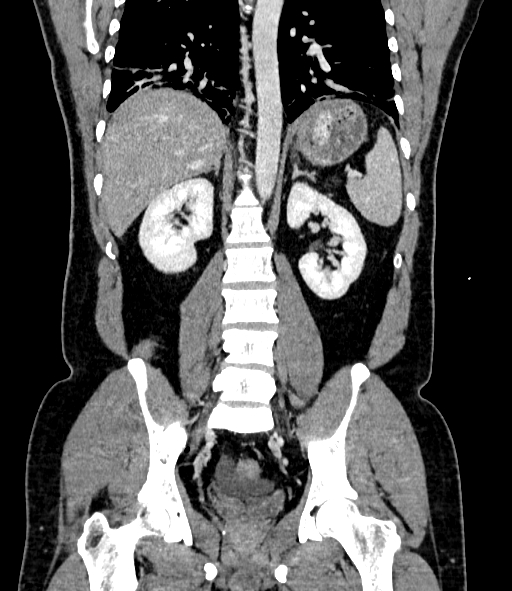 Acute pancreatitis (Radiopaedia 87428-103757 Coronal C+ portal venous phase 62).jpg