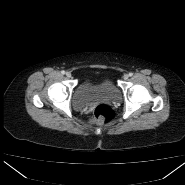 Acute pancreatitis - Balthazar C (Radiopaedia 26569-26714 Axial C+ portal venous phase 91).jpg