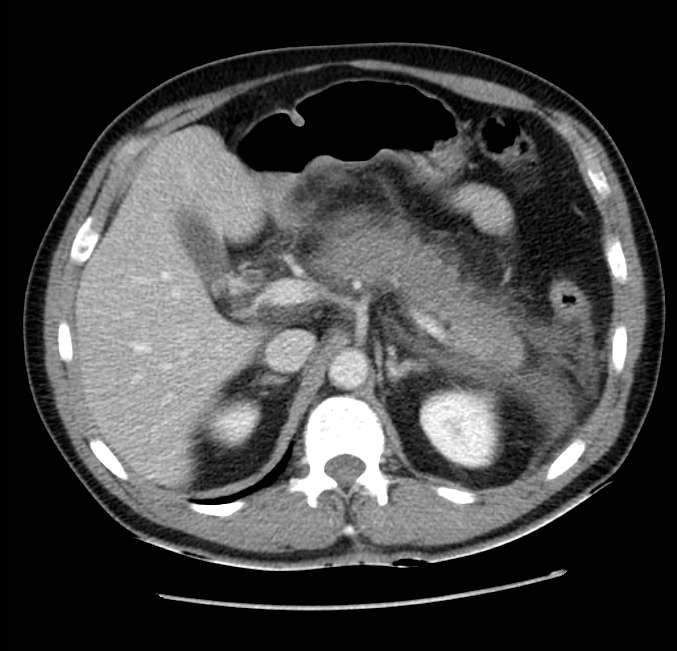 Acute pancreatitis - Balthazar E (Radiopaedia 23080-23110 Axial C+ portal venous phase 20).jpg