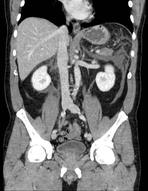 Acute pancreatitis - Balthazar E (Radiopaedia 23080-23110 Coronal C+ portal venous phase 44).jpg
