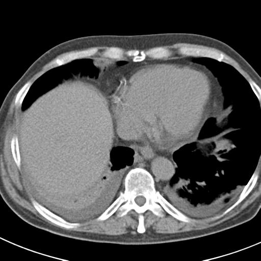 File:Acute pancreatitis and walled-off necrosis (Radiopaedia 29888-30403 Axial non-contrast 4).jpg