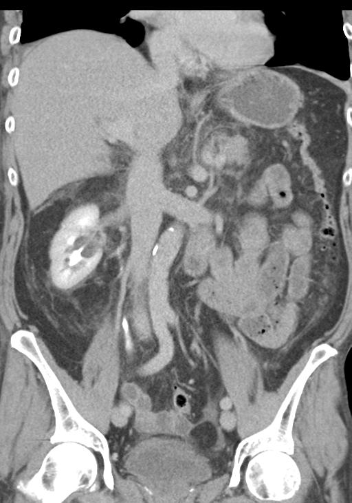 Acute pancreatitis and walled-off necrosis (Radiopaedia 29888-30403 E 30).jpg