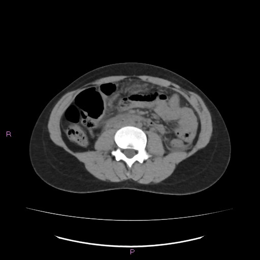File:Acute pancreatitis secondary to stone at minor papilla and pancreatic divisum (Radiopaedia 76570-88333 Axial non-contrast 39).jpg