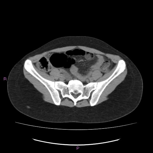 Acute pancreatitis secondary to stone at minor papilla and pancreatic divisum (Radiopaedia 76570-88333 Axial non-contrast 56).jpg