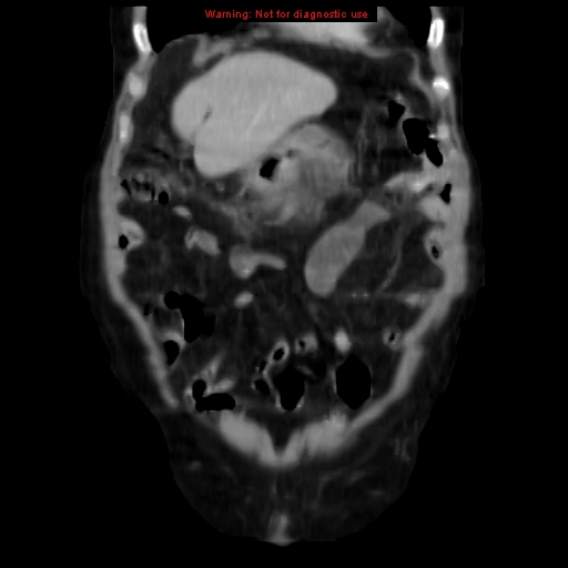 Acute pancreatitis with incidental pancreatic lipoma (Radiopaedia 10190-10730 Coronal C+ portal venous phase 15).jpg