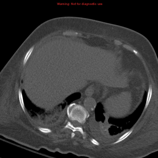 Acute pulmonary embolism (Radiopaedia 13286-13289 Axial C+ CTPA 57).jpg