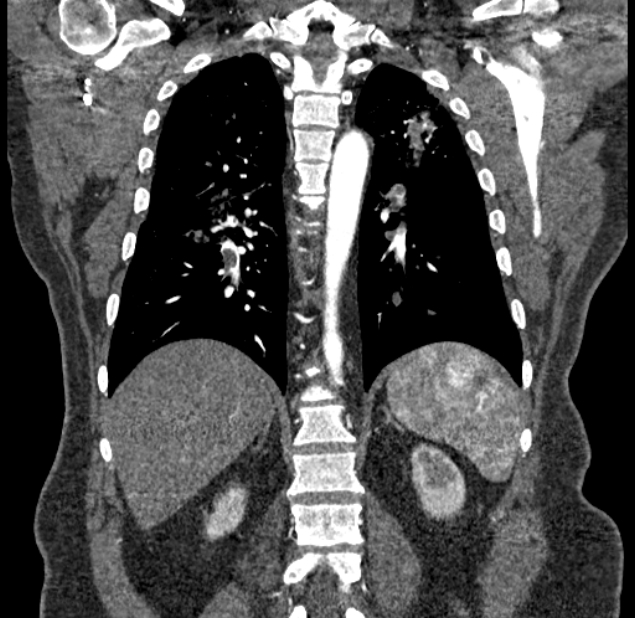 Acute pulmonary embolism with pulmonary infarcts (Radiopaedia 77688-89908 Coronal C+ CTPA 71).jpg