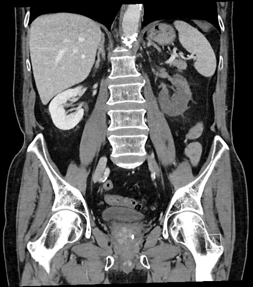 Acute renal infarction (Radiopaedia 59375-66736 Coronal C+ portal venous phase 38).jpg