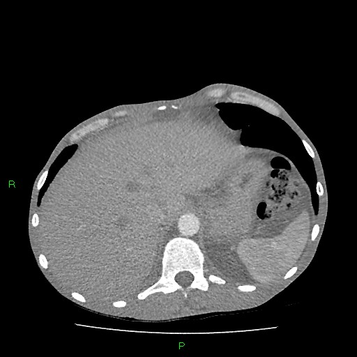 File:Acute right lung abscess (Radiopaedia 34806-36258 Axial C+ arterial phase 170).jpg