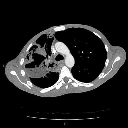 File:Acute right lung abscess (Radiopaedia 34806-36258 Axial C+ arterial phase 62).jpg