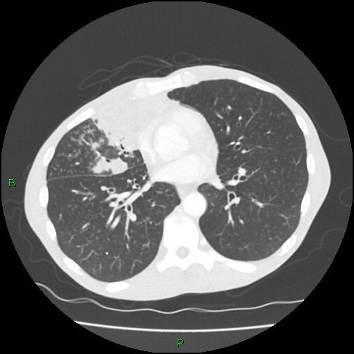 Acute right lung abscess (Radiopaedia 34806-36258 Axial lung window 114).jpg