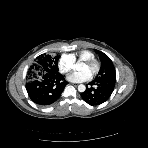 File:Acute segmental pulmonary emboli and pulmonary infarction (Radiopaedia 62264-70444 Axial C+ CTPA 70).jpg