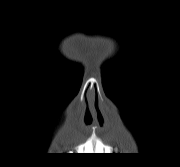Acute sinusitis (Radiopaedia 23161-23215 Coronal bone window 16).jpg