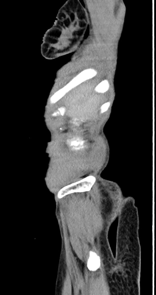 Acute small bowel (ileal) volvulus (Radiopaedia 71740-82139 Sagittal C+ portal venous phase 148).jpg