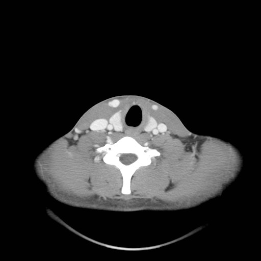 File:Acute submandibular sialadenitis secondary to ductal stone (Radiopaedia 27999-28267 Axial C+ delayed 36).jpg