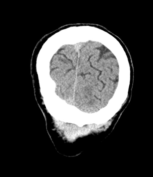 File:Acute superior cerebellar artery territory infarct (Radiopaedia 84104-99359 Coronal non-contrast 78).jpg