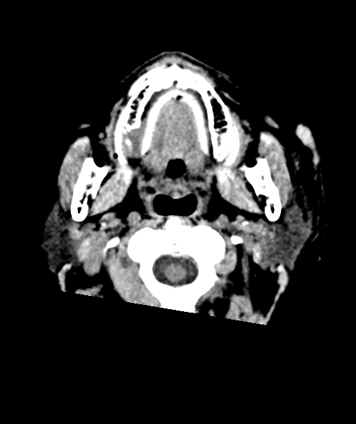 Acute traumatic subdural hematoma (Radiopaedia 82921-97257 Axial non-contrast 66).jpg