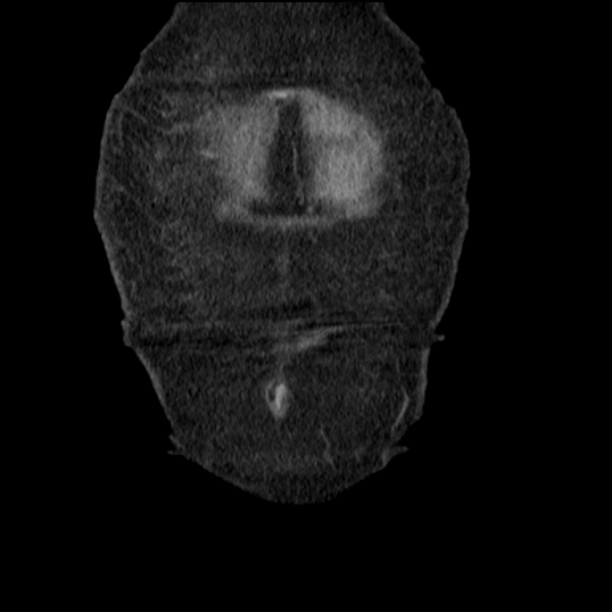 Acute tubular necrosis (Radiopaedia 28077-28334 D 10).jpg