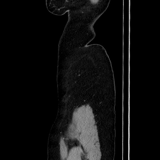 Acute uncomplicated appendicitis (Radiopaedia 73704-84499 Sagittal C+ portal venous phase 38).jpg