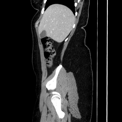 Acute uncomplicated appendicitis (Radiopaedia 73704-84499 Sagittal C+ portal venous phase 63).jpg