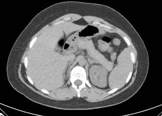 Acute unilateral nonhemorrhagic adrenal infarction (Radiopaedia 67560-76957 Axial non-contrast 30).jpg