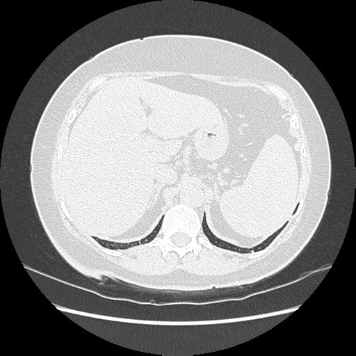 Adenocarcinoma in situ of lung (Radiopaedia 38685-40829 B 212).png