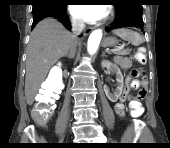 Adenocarcinoma of cecum (Radiopaedia 59222-66549 Coronal C+ arterial phase 41).jpg