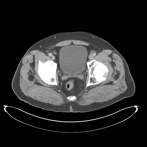 Adenocarcioma of rectum- T1 lesion (Radiopaedia 36921-38547 Axial C+ portal venous phase 82).png