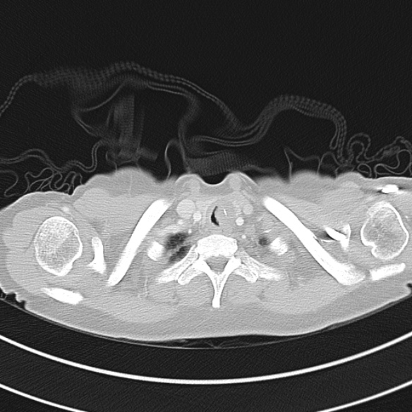 File:Adenocystic carcinoma of the trachea (Radiopaedia 47677-52525 Axial lung window 29).jpg