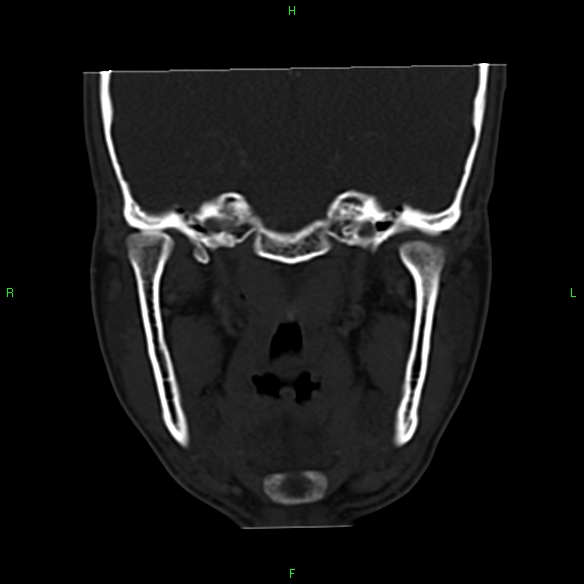 File:Adenoid cystic carcinoma of hard palate (Radiopaedia 26137-26273 Coronal bone window 21).jpg