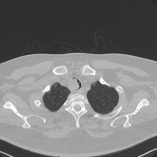 Adenoid cystic carcinoma of the trachea (Radiopaedia 49042-54137 Axial lung window 39).jpg
