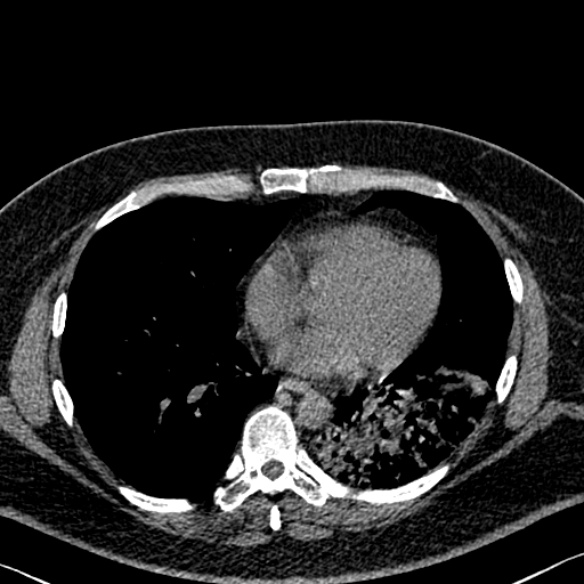 Adenoid cystic carcinoma of the trachea (Radiopaedia 49042-54137 Axial non-contrast 221).jpg