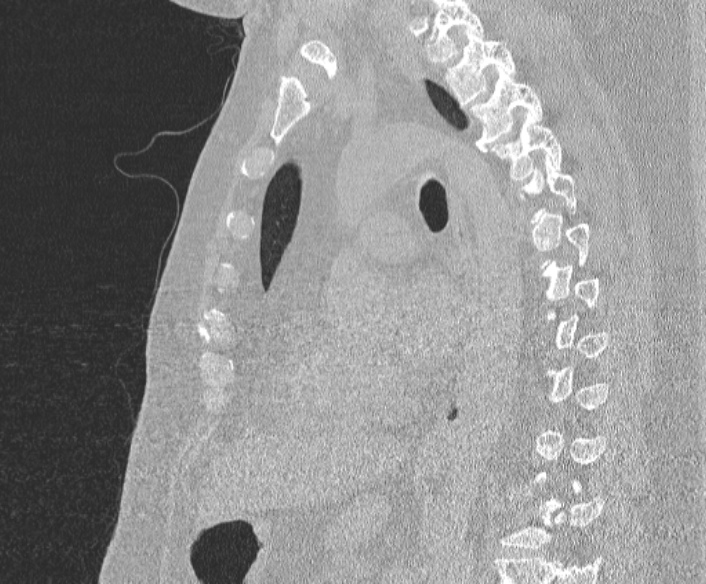 File:Adenoid cystic carcinoma of the trachea (Radiopaedia 49042-54137 Sagittal lung window 260).jpg
