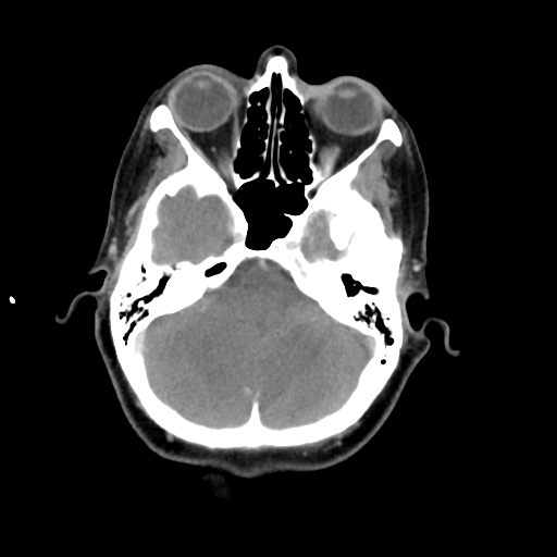 File:Adenoid cystic tumor of palate (Radiopaedia 46980-51518 Axial C+ delayed 14).png